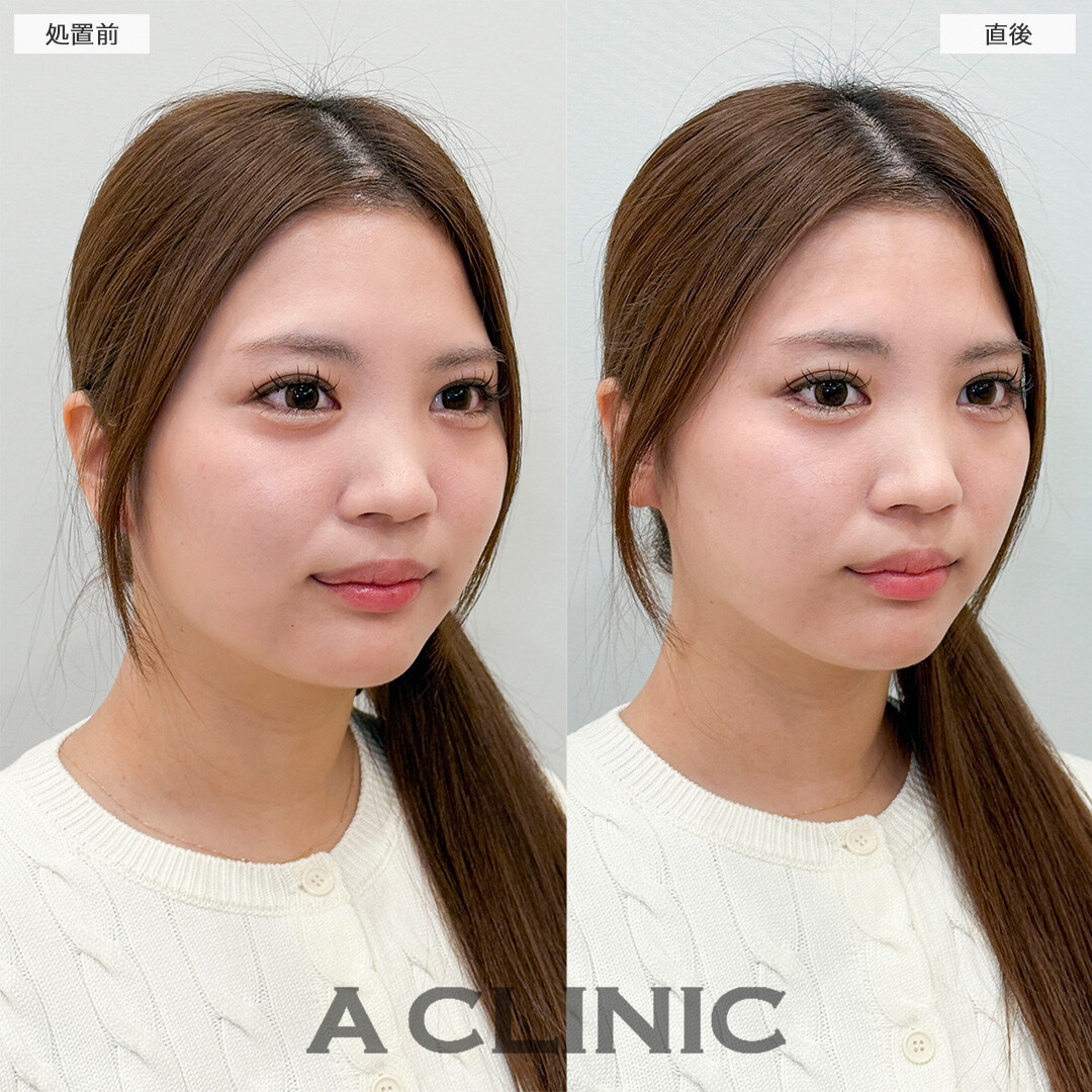 Aスレッドで即日リフトアップが叶う！処置前と直後の症例です(20代女性)