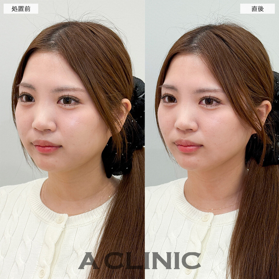 Aスレッドで即日リフトアップが叶う！処置前と直後の症例です(20代女性)