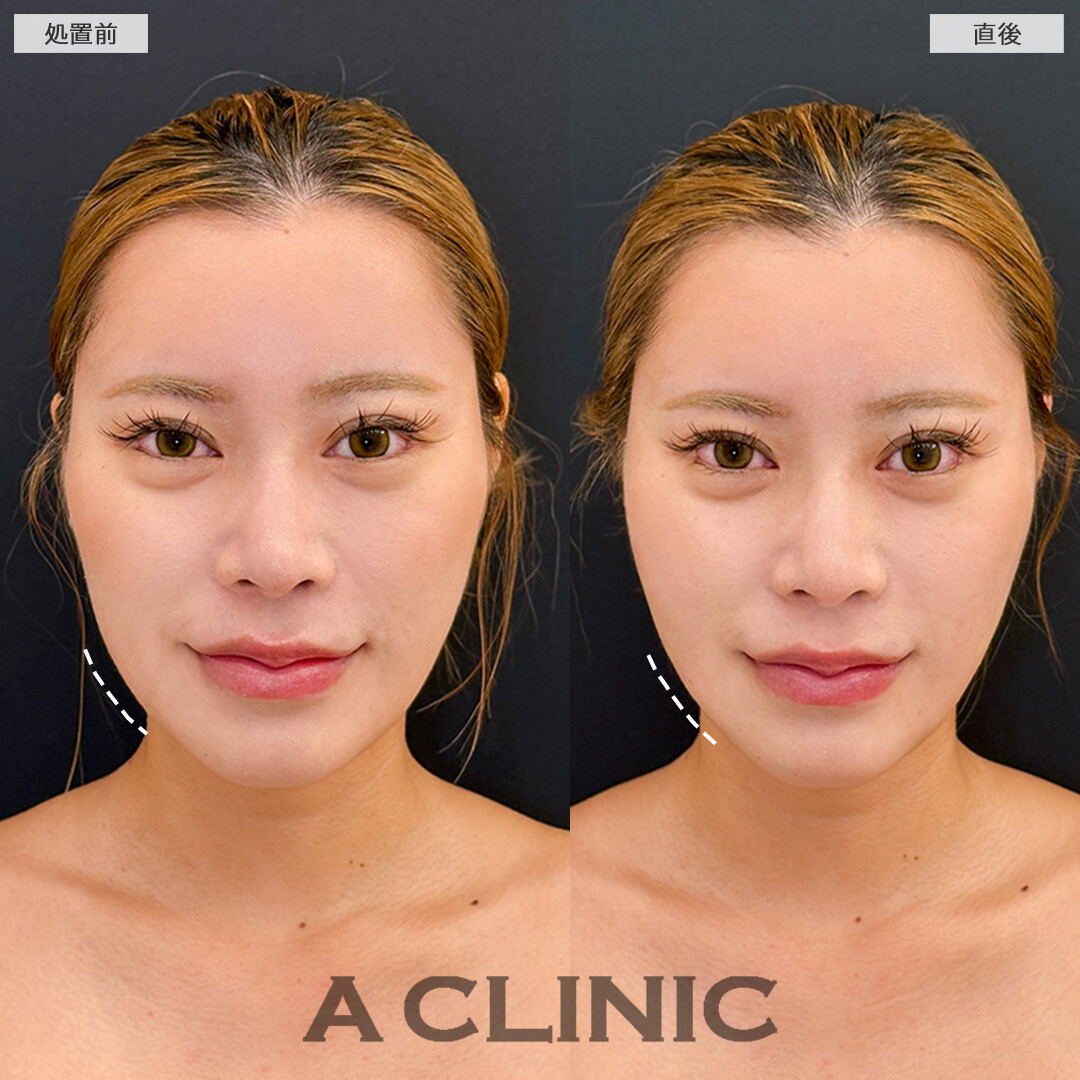 Aスレッドで整ったフェイスラインに！こちら処置前と直後の症例です(20代女性)