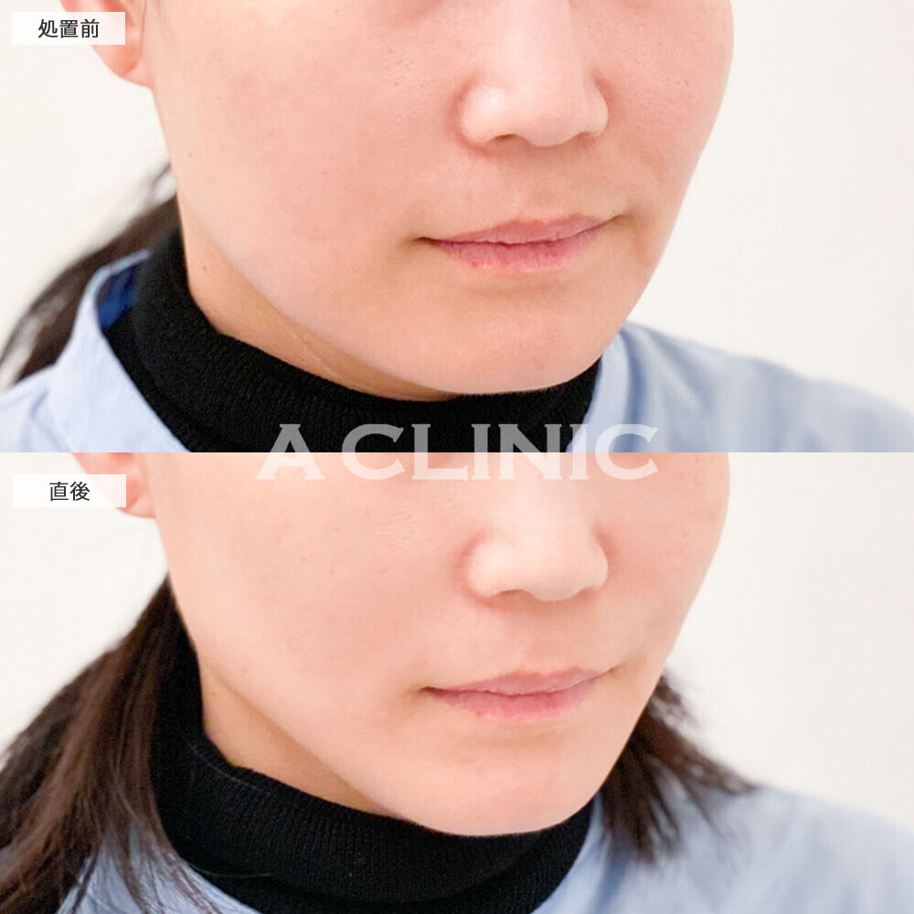 Aスレッドでスッキリした印象の卵型フェイスになりました！こちら処置前と直後の症例です(30代女性)