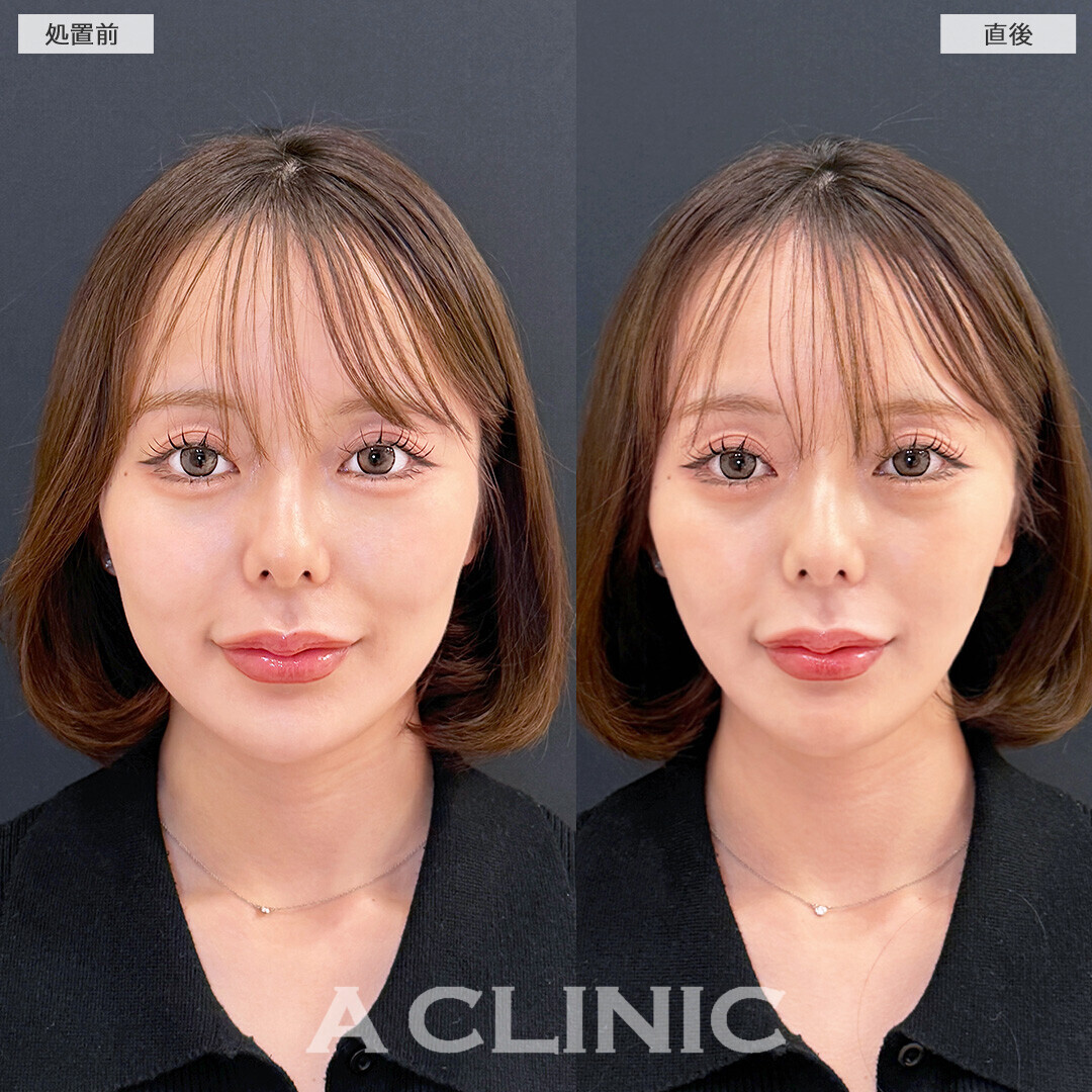 Aスレッドでひと回りスッキリ見える小顔になりました！こちら処置前と直後の症例です(20代女性)