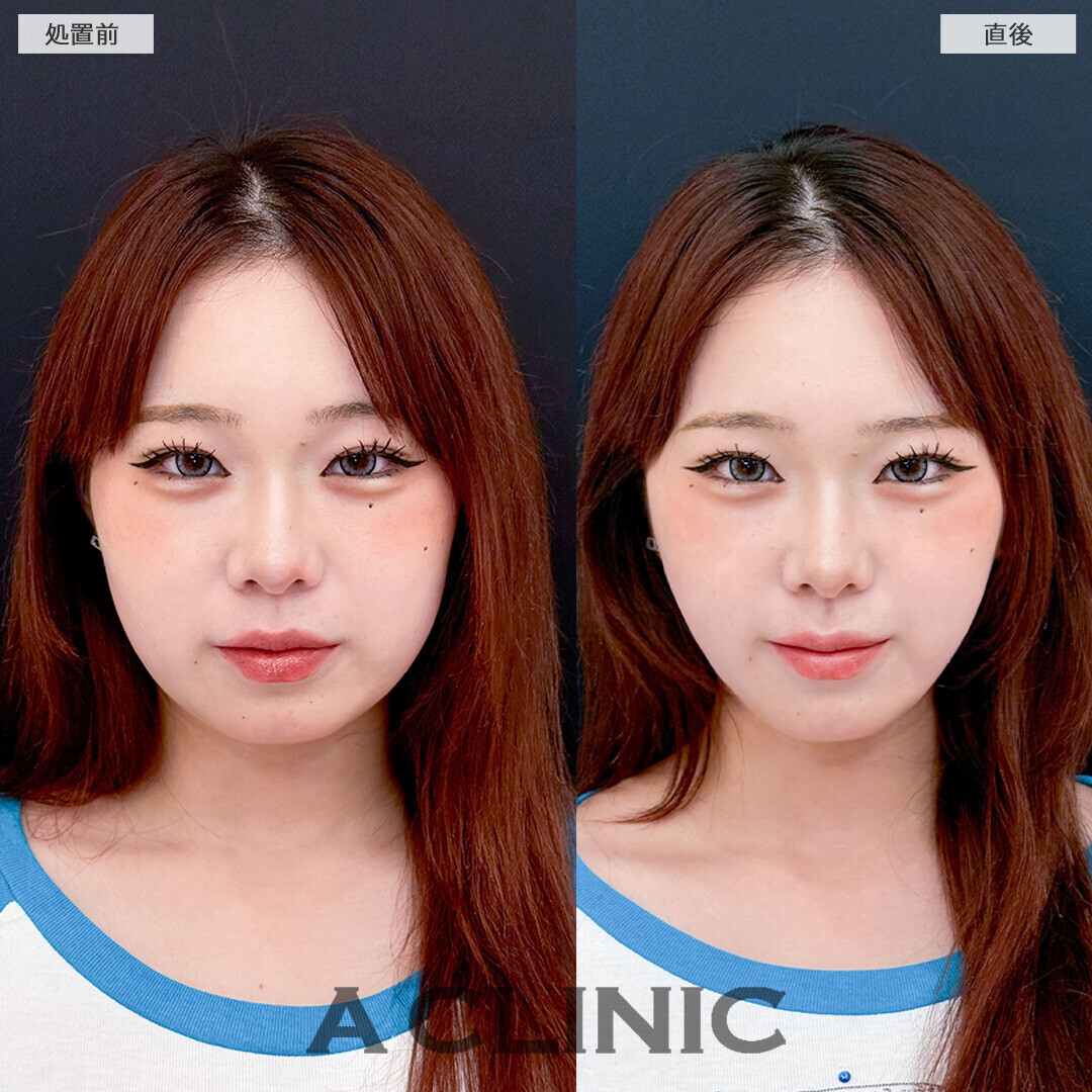 Aスレッドで丸みのある輪郭からスッキリ小顔になりました！こちら処置前と直後の症例です(20代女性)