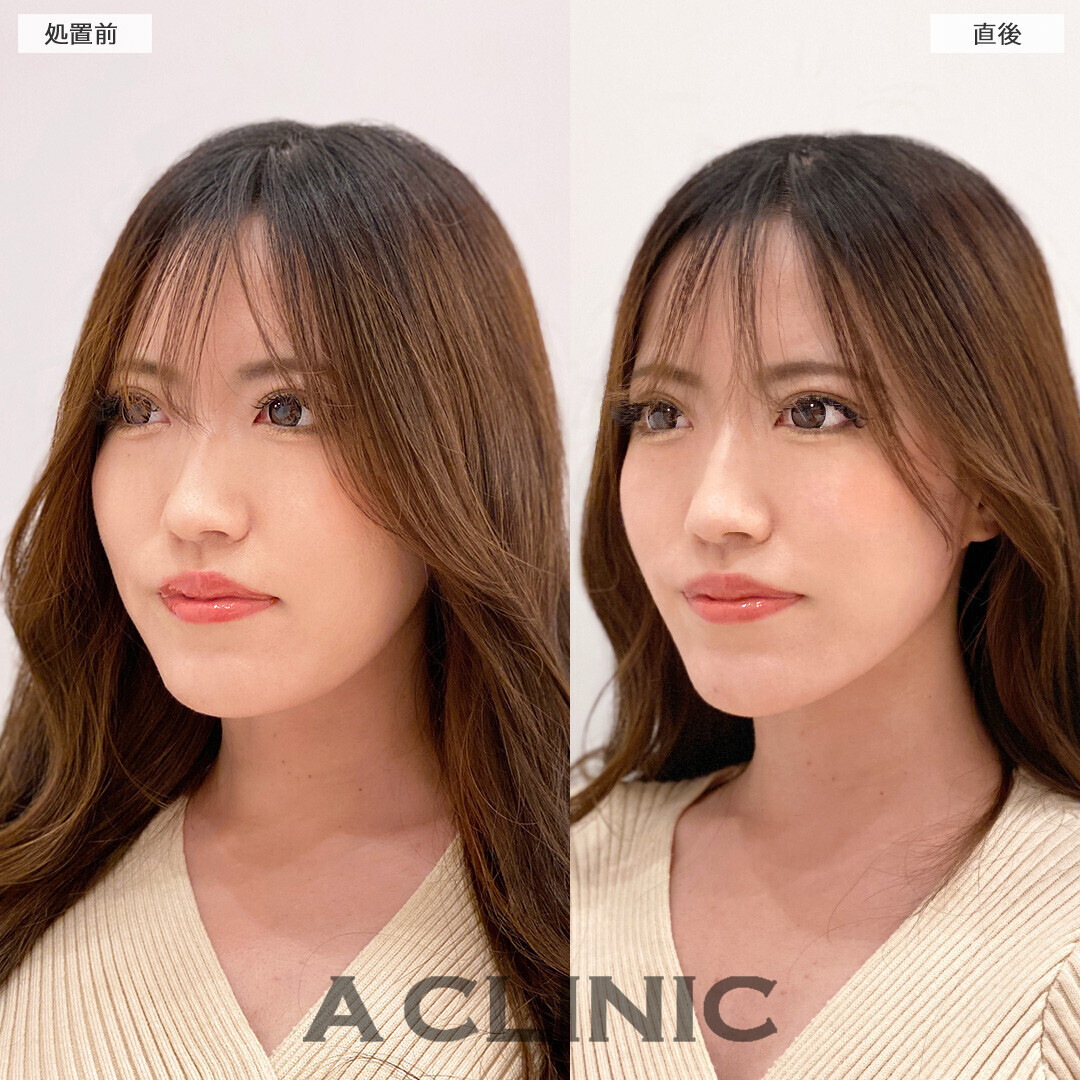 Aスレッドとあごへのヒアルロン酸注入でバランスの良い輪郭になりました！こちら処置前と直後の症例です(20代女性)