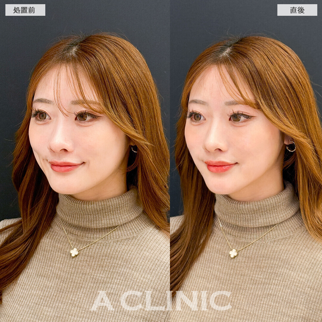 Aスレッドで輪郭が整い更に美人に！こちら処置前と直後の症例です(20代女性)