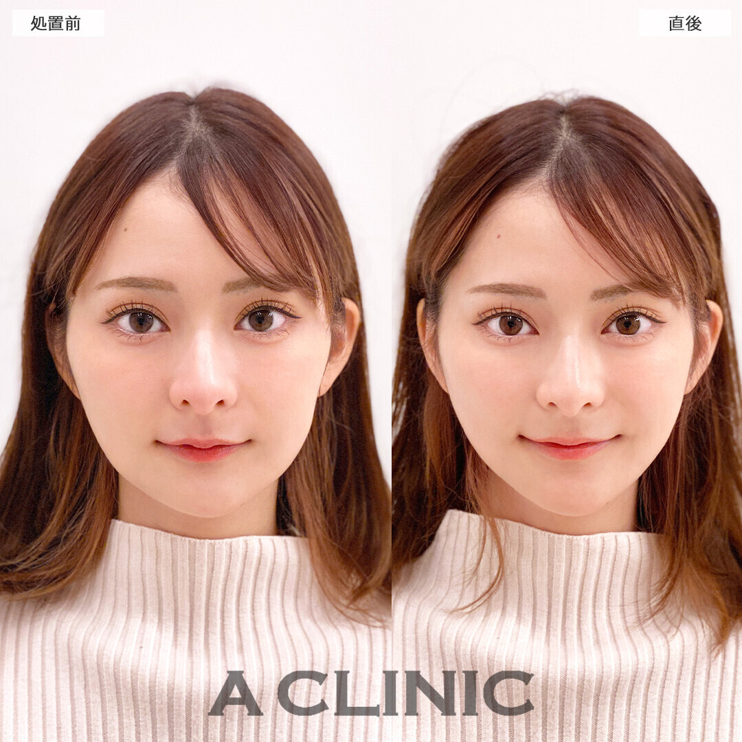 Aスレッドで頬の余白が減り更に小顔になりました！こちら処置前と直後の症例です(20代女性)