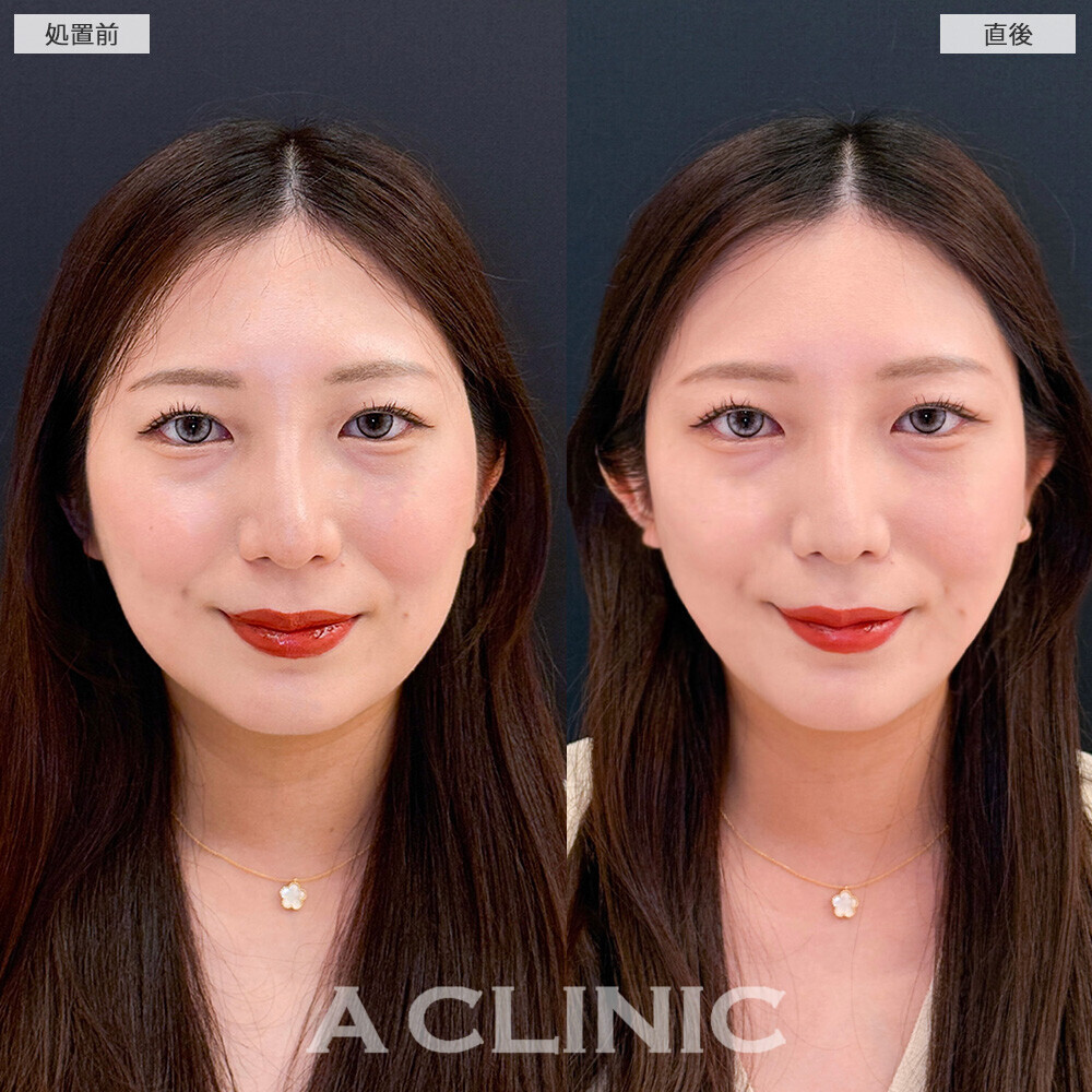 Aスレッドで丸顔から卵型の輪郭に！こちら処置前と直後の症例です(20代女性)