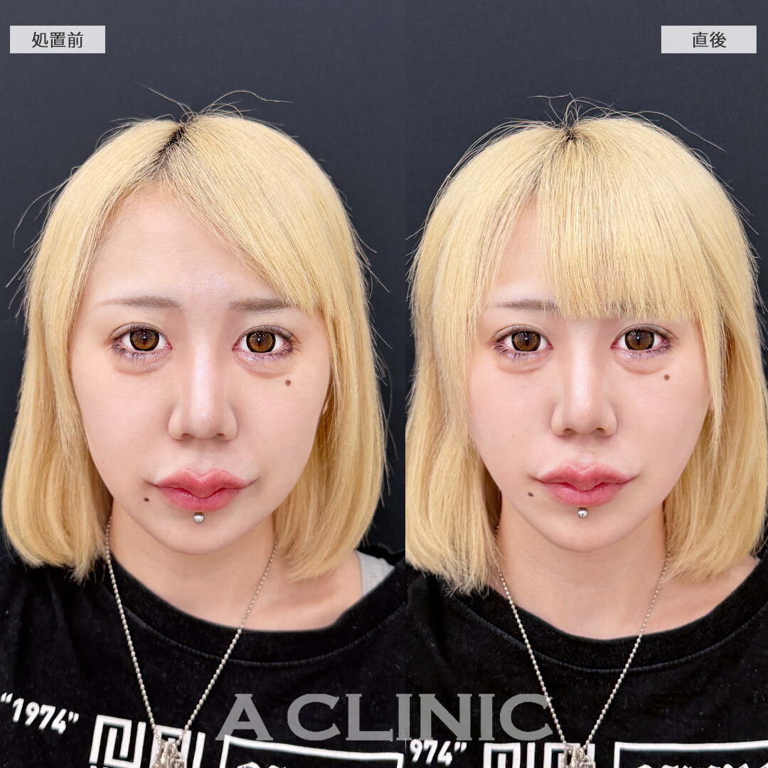 Aスレッドでもたつきをグイっと引き上げて超シャープなフェイスラインに！こちら処置前と直後の症例です(20代女性)
