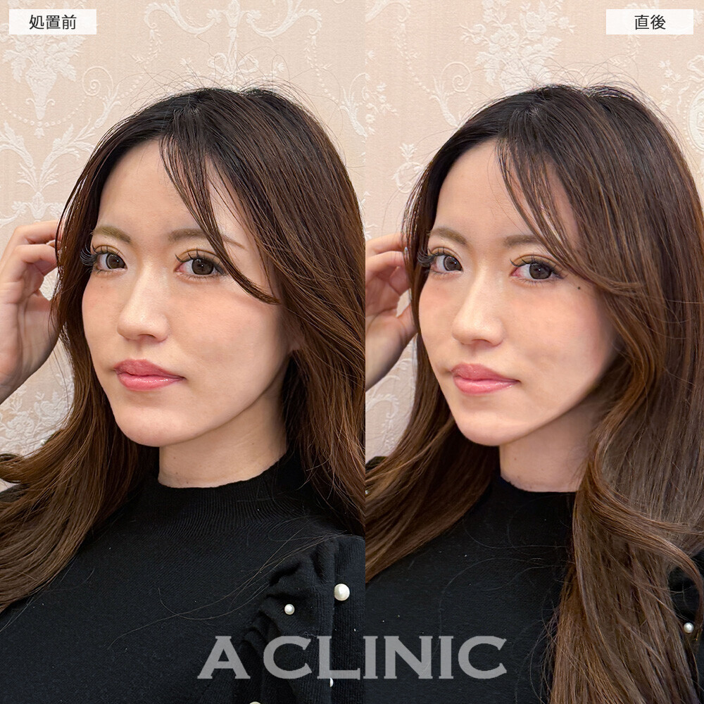 Aスレッドで気になる口横のたるみも改善！こちら処置前と直後の症例です(30代女性)