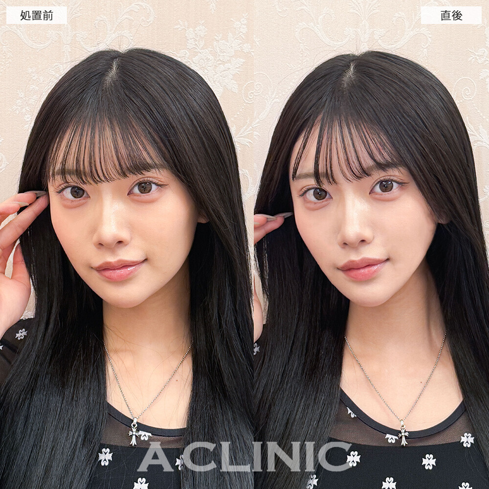 AスレッドでVフェイスになり更に小顔を手に入れました！こちら処置前と直後の症例です(20代女性)