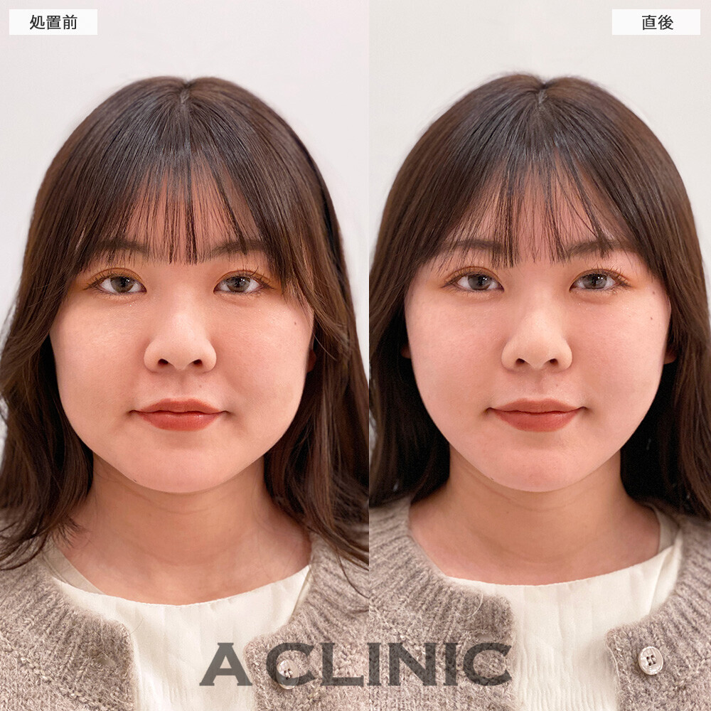 Aスレッドで口横のもたつきリフトアップ！こちら処置前と直後の症例です(20代女性)
