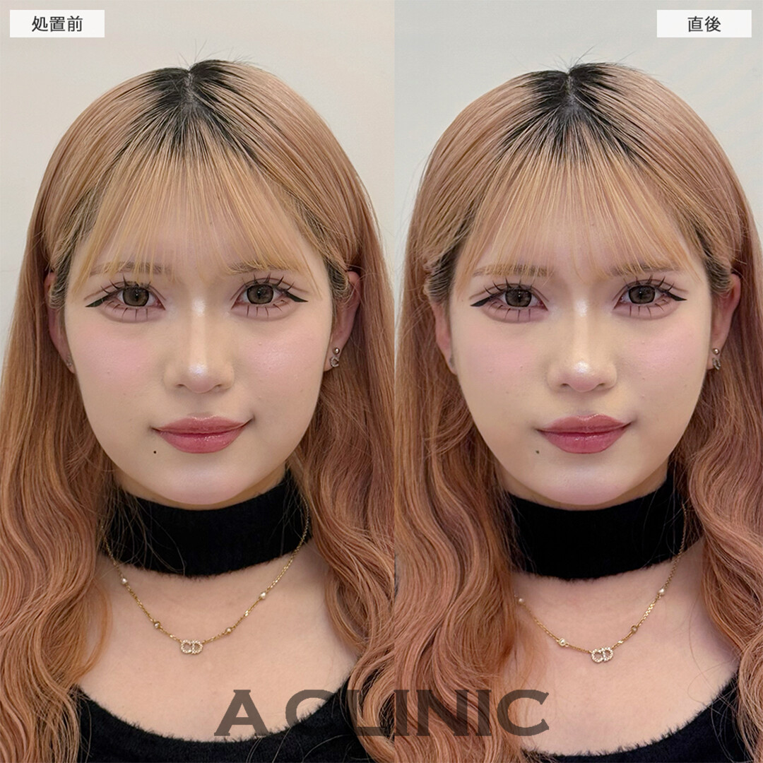 Aスレッドで丸顔がここまで変わりました！こちら処置前と直後の症例です(20代女性)