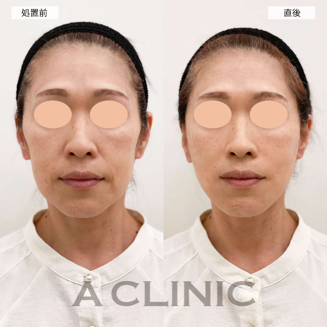 Aスレッドでほうれい線がかなり薄くなりました！こちら処置前と直後の症例です(50代女性)