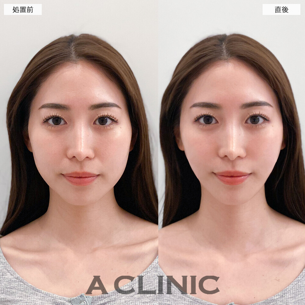 Aスレッドで丸顔改善！こちら処置前と直後の症例です(20代女性)