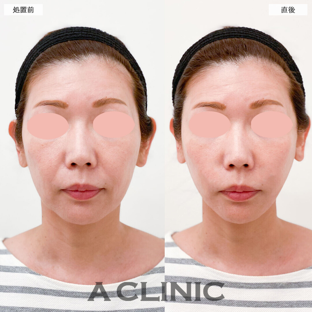 Aスレッドならわずか15分でほうれい線が消えた！こちら処置前と直後の症例です(40代女性)