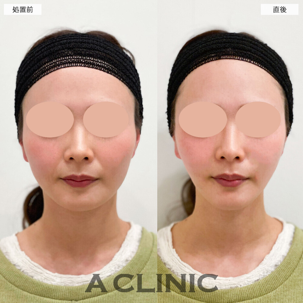 Aスレッドでほうれい線も改善され若返りました！こちら処置前と直後の症例です(20代女性)