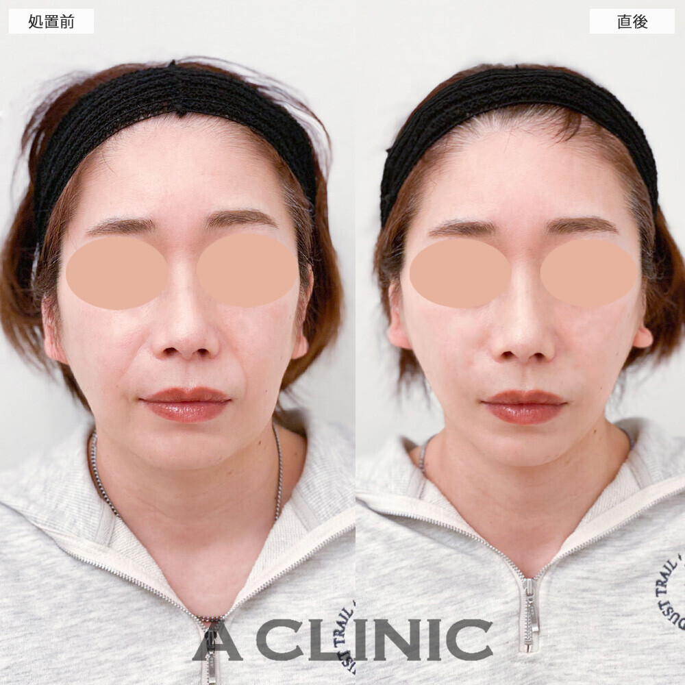 Aスレッドでほうれい線も改善され輪郭が整いました！こちら処置前と直後の症例です(50代女性)