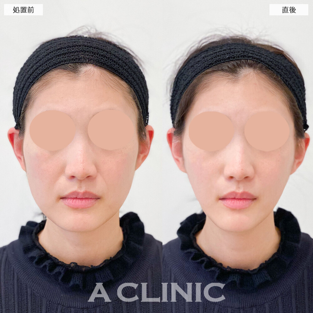 Aスレッドで顔の横幅狭くなり綺麗なVフェイスに！こちら処置前と直後の症例です(30代女性)
