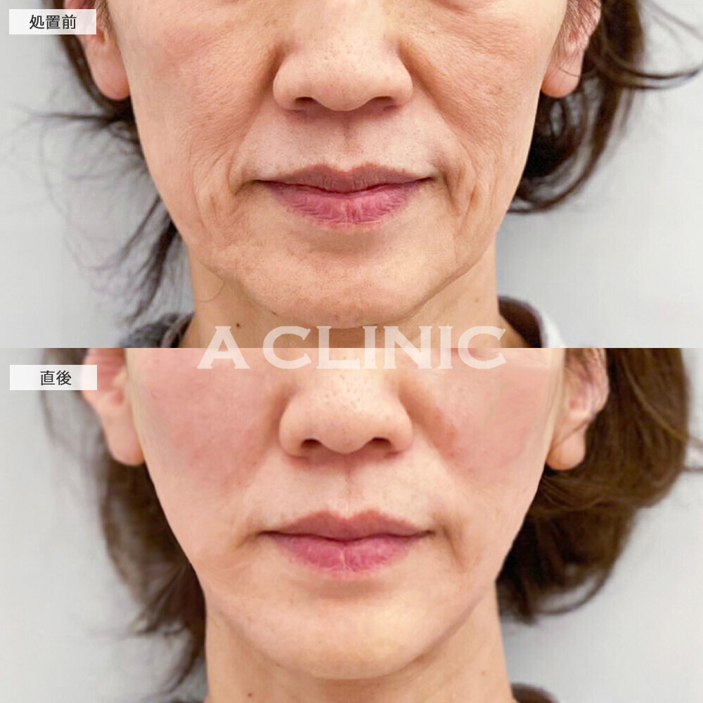 Aスレッドとボトックス注射(しわ)で深いしわも改善！こちら処置前から1ヶ月後の症例です(60代女性)