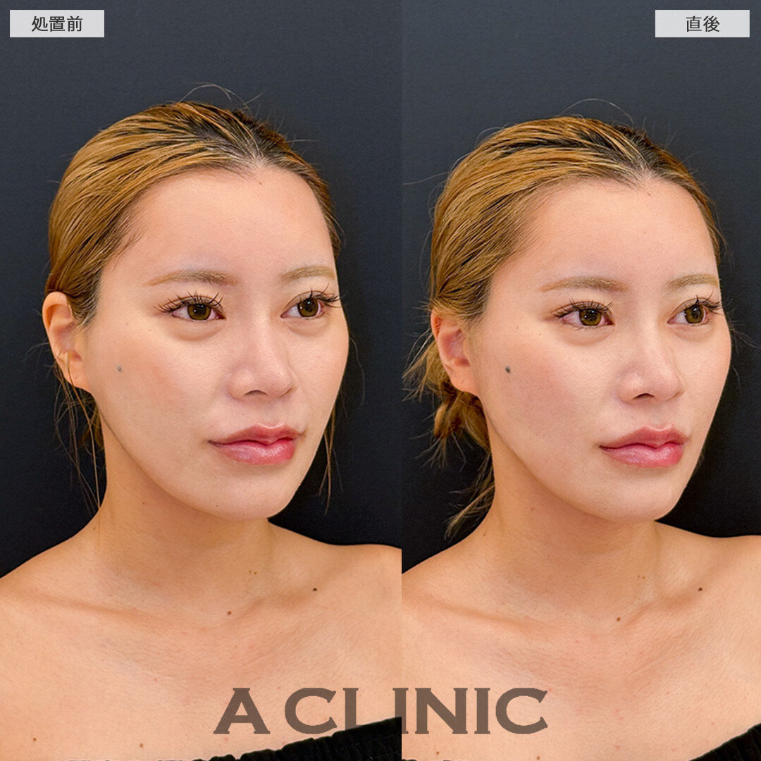 Aスレッドで整ったフェイスラインに！こちら処置前と直後の症例です(20代女性)