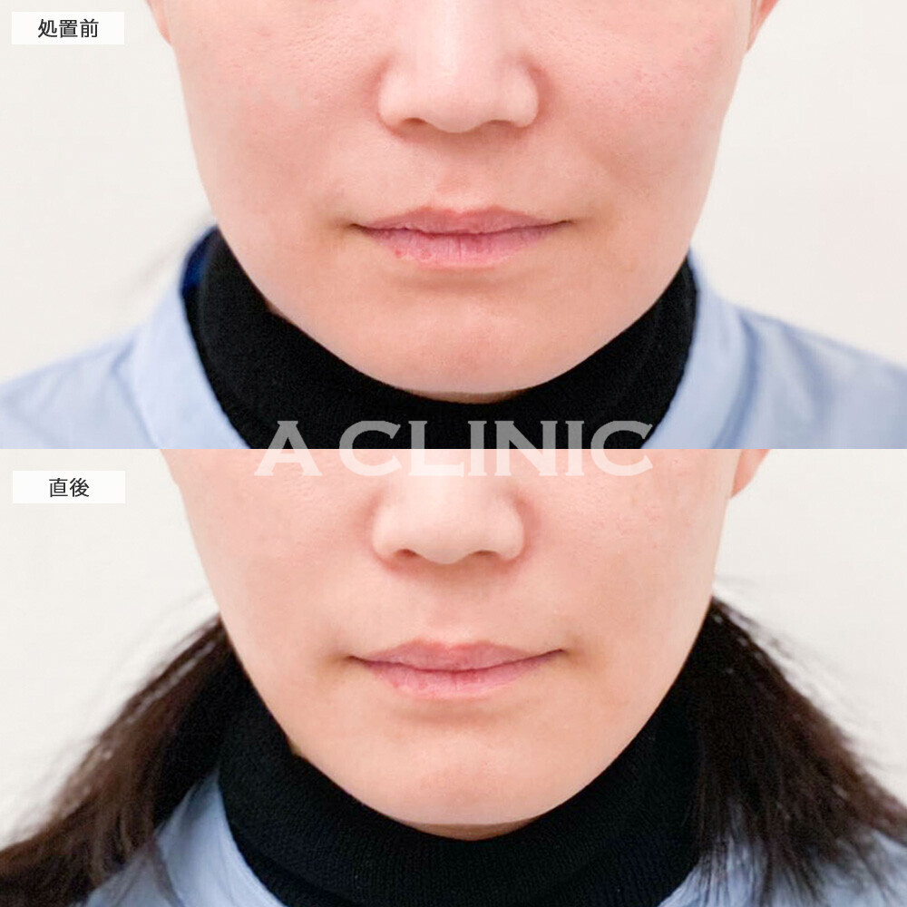 Aスレッドでスッキリした印象の卵型フェイスになりました！こちら処置前と直後の症例です(30代女性)