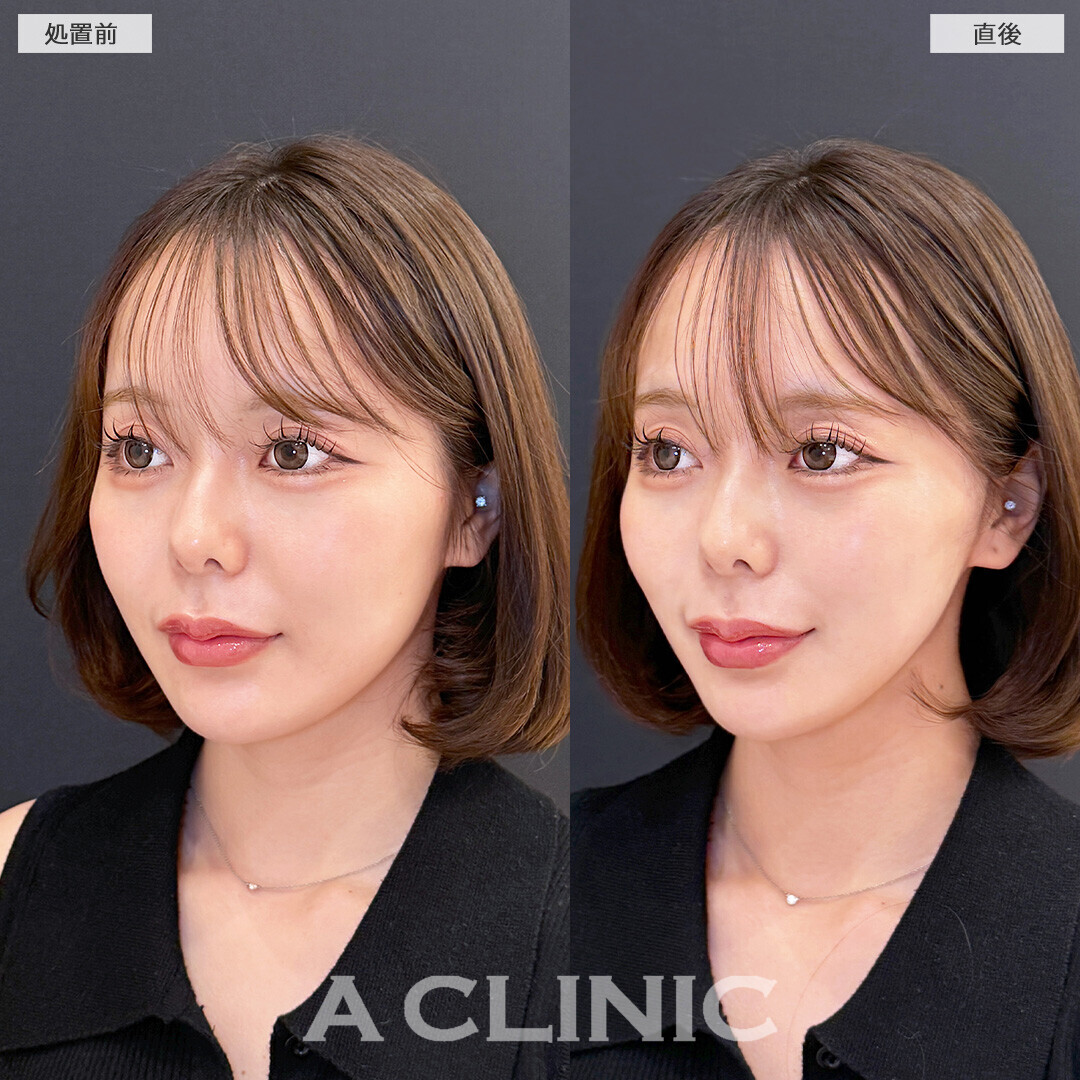 Aスレッドでひと回りスッキリ見える小顔になりました！こちら処置前と直後の症例です(20代女性)