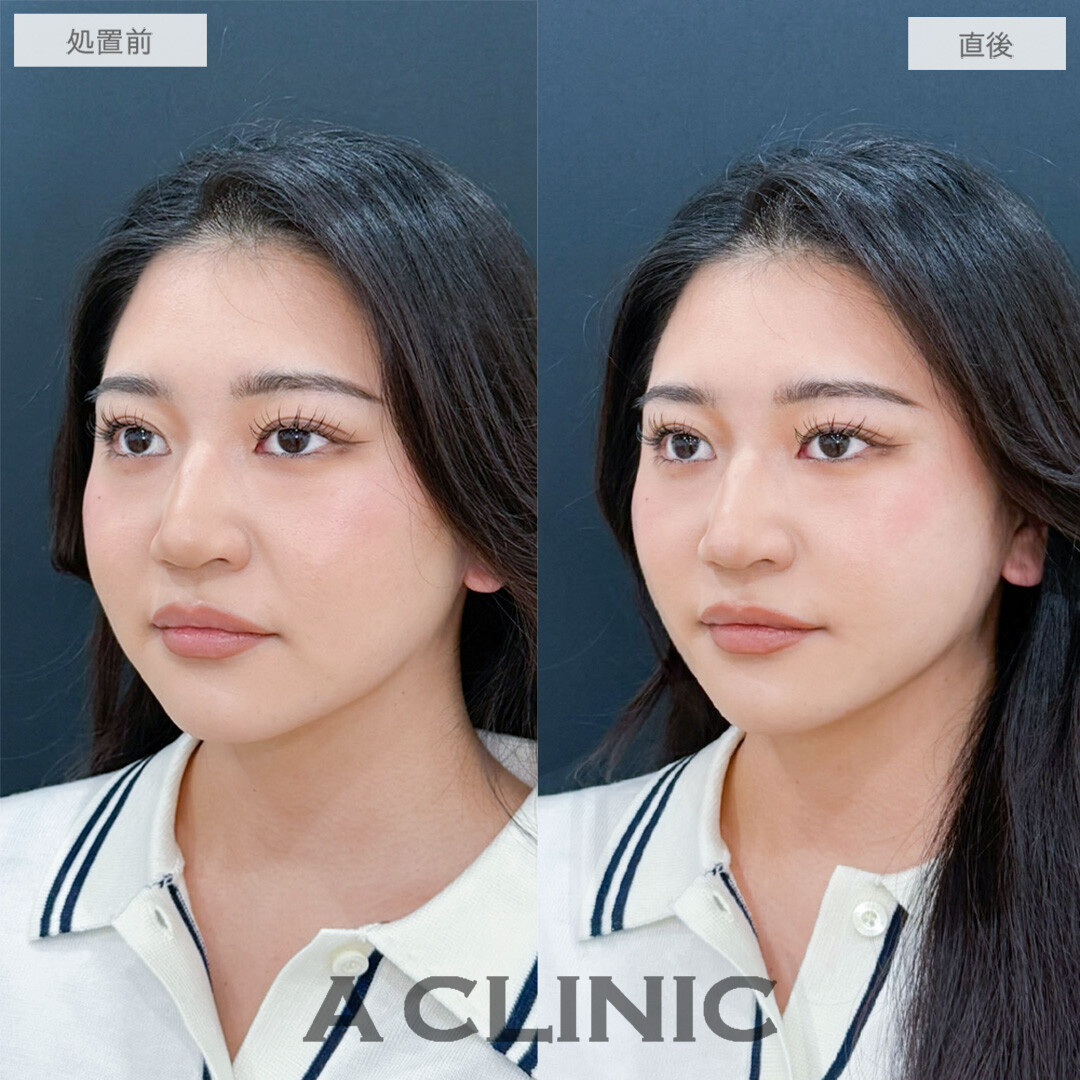 Aスレッドの定期的なメンテナンスで常に小顔に！こちら処置前と直後の症例です(20代女性)