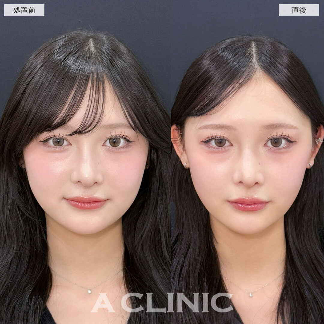 Aスレッドで理想のVフェイスを叶えられます！こちら処置前と直後の症例です(10代女性)
