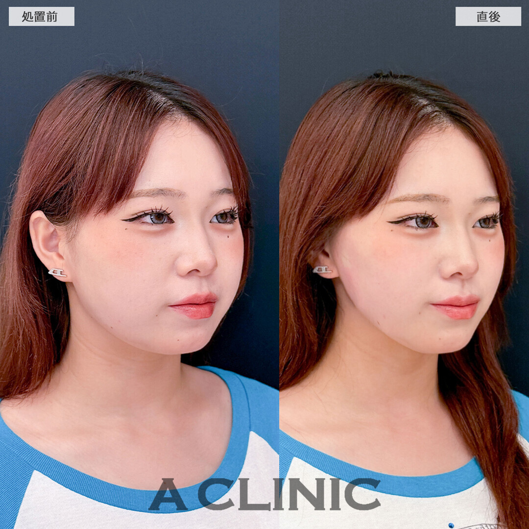 Aスレッドで丸みのある輪郭からスッキリ小顔になりました！こちら処置前と直後の症例です(20代女性)