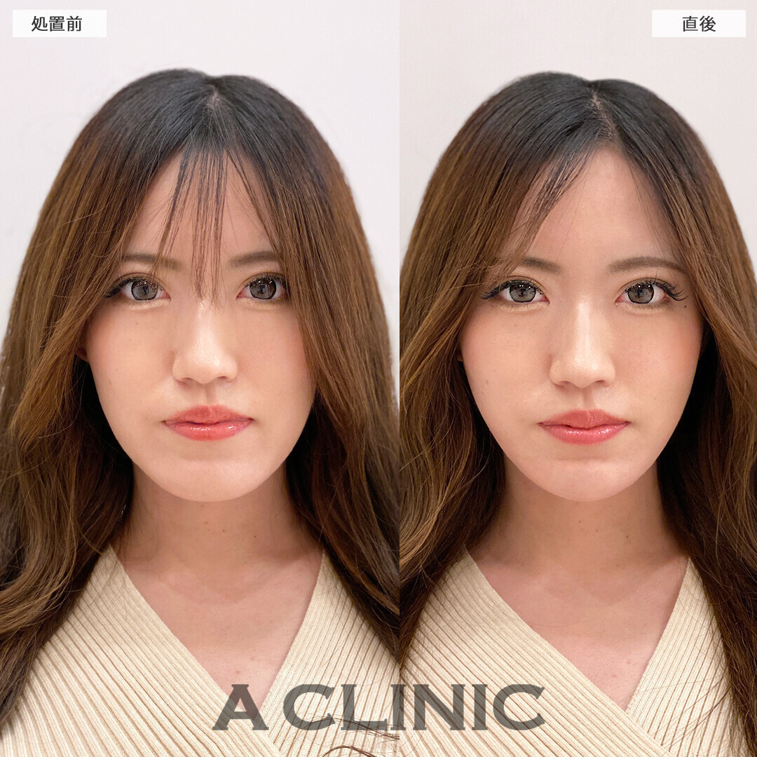 Aスレッドとあごへのヒアルロン酸注入でバランスの良い輪郭になりました！こちら処置前と直後の症例です(20代女性)
