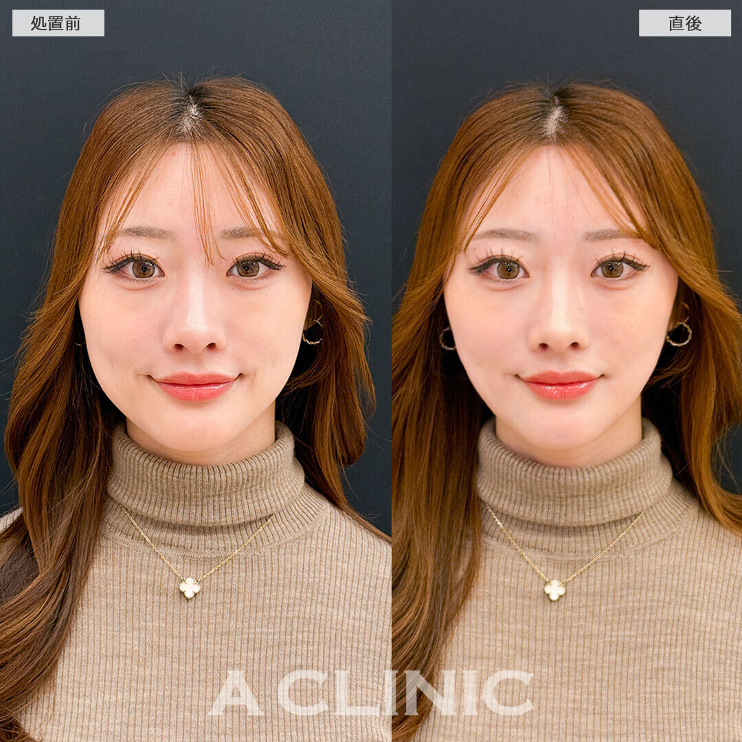 Aスレッドで輪郭が整い更に美人に！こちら処置前と直後の症例です(20代女性)