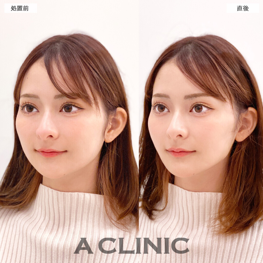 Aスレッドで頬の余白が減り更に小顔になりました！こちら処置前と直後の症例です(20代女性)