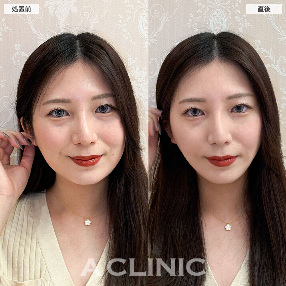 Aスレッドで丸顔から卵型の輪郭に！こちら処置前と直後の症例です(20代女性)