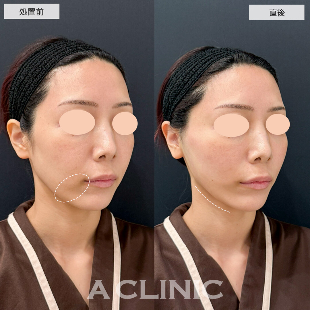 Aスレッドで口横のポニョが改善しスッキリした小顔に!こちら処置前と直後の症例です(30代女性)