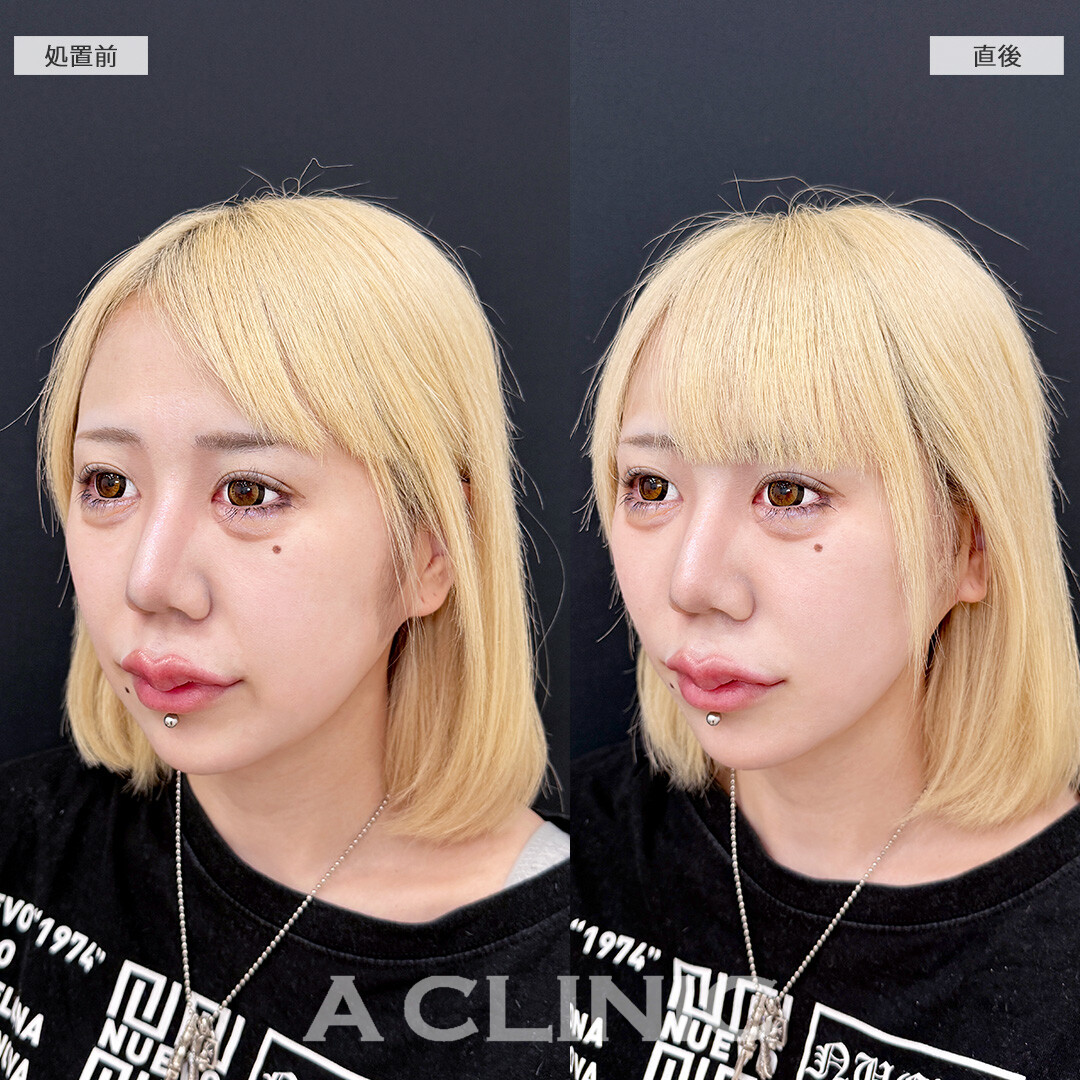 Aスレッドでもたつきをグイっと引き上げて超シャープなフェイスラインに！こちら処置前と直後の症例です(20代女性)