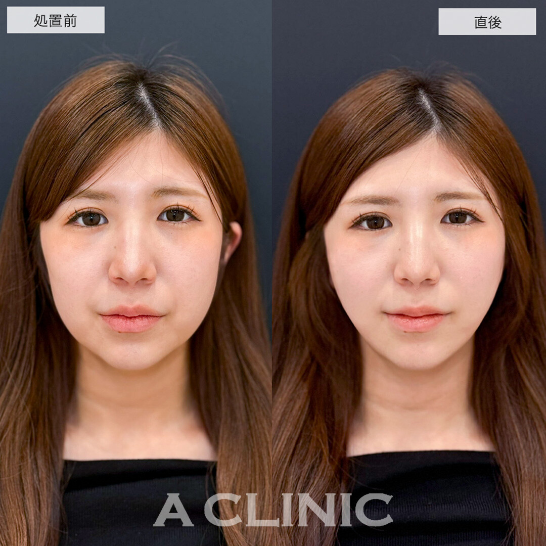 Aスレッドで即日理想の逆三角形の輪郭に!こちら処置前と直後の症例です(20代女性)