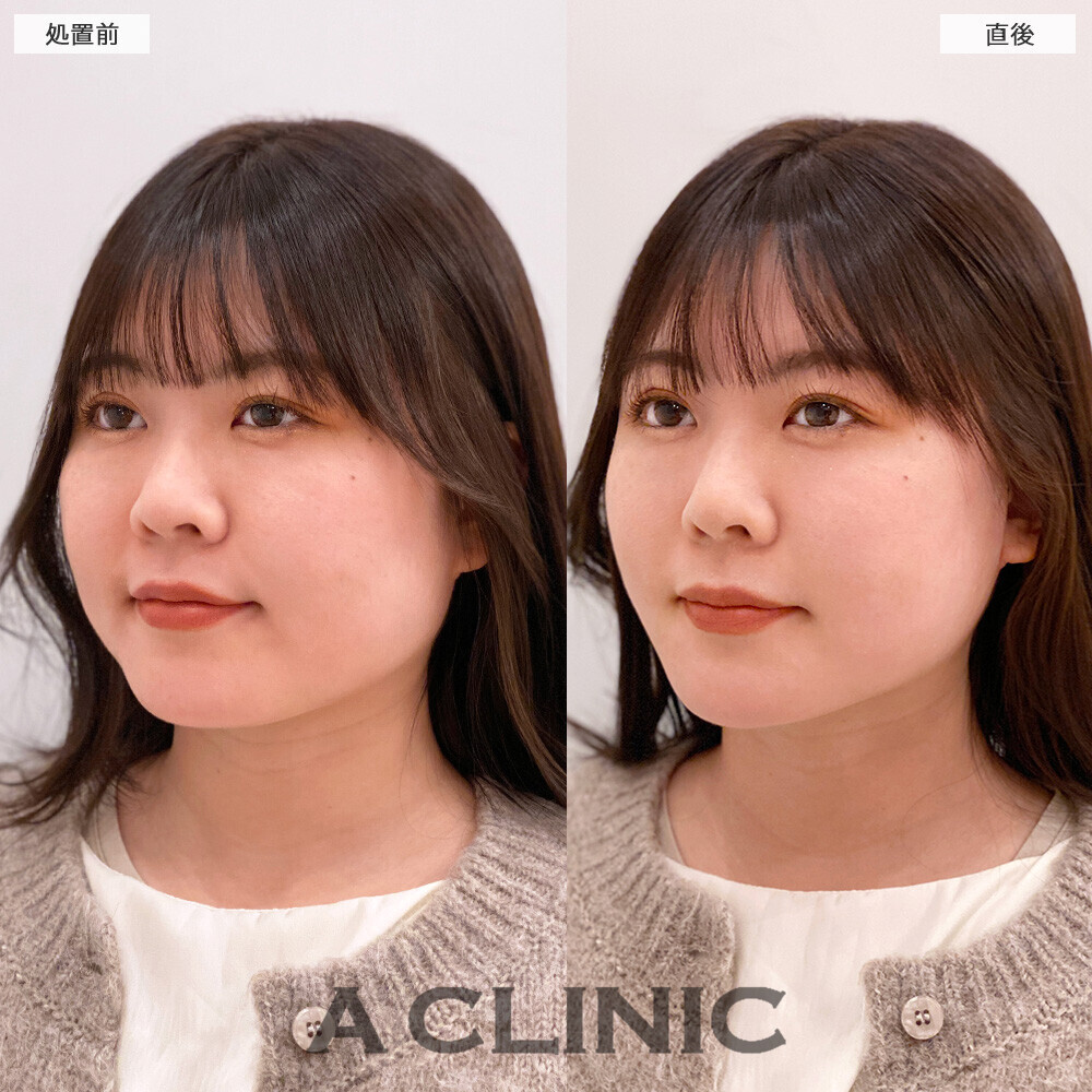 Aスレッドで口横のもたつきリフトアップ！こちら処置前と直後の症例です(20代女性)