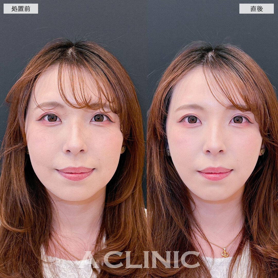 Aスレッドは不自然にならずに小顔になれます！こちら処置前と直後の症例です(30代女性)
