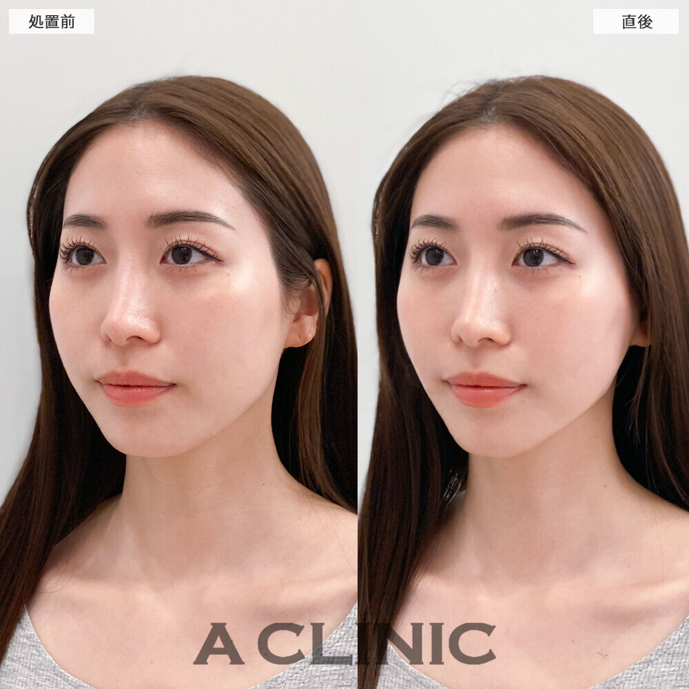 Aスレッドで丸顔改善！こちら処置前と直後の症例です(20代女性)