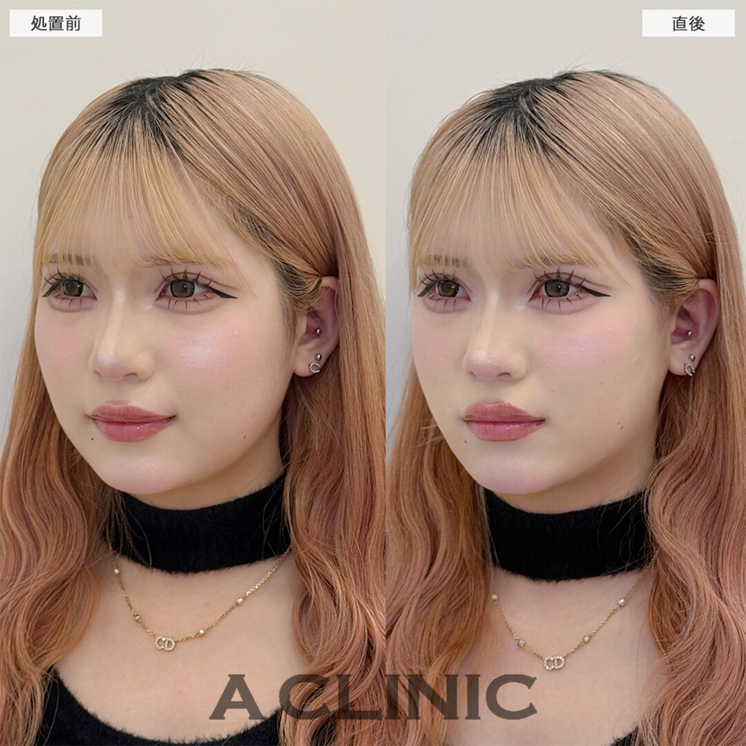 Aスレッドで丸顔がここまで変わりました！こちら処置前と直後の症例です(20代女性)