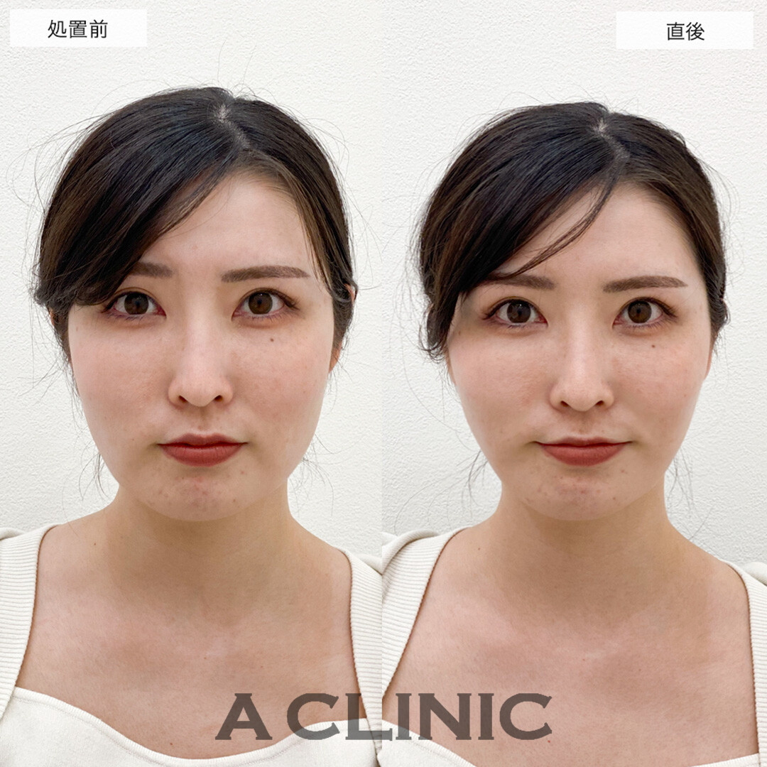 Aスレッドで輪郭のもたつきが引き上がり中顔面短縮!こちら処置前と直後の症例です(20代女性)