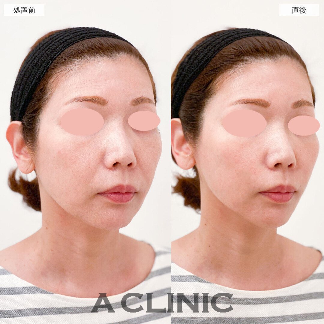 Aスレッドならわずか15分でほうれい線が消えた！こちら処置前と直後の症例です(40代女性)