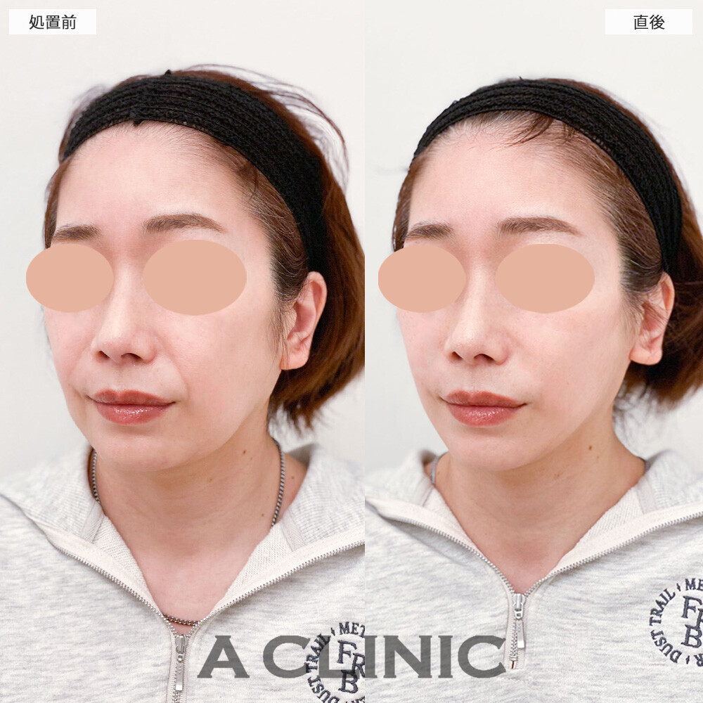 Aスレッドでほうれい線も改善され輪郭が整いました！こちら処置前と直後の症例です(50代女性)