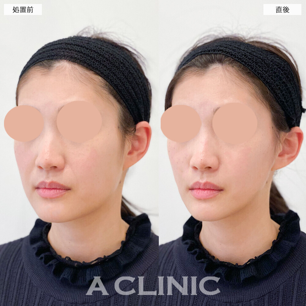 Aスレッドで顔の横幅狭くなり綺麗なVフェイスに！こちら処置前と直後の症例です(30代女性)