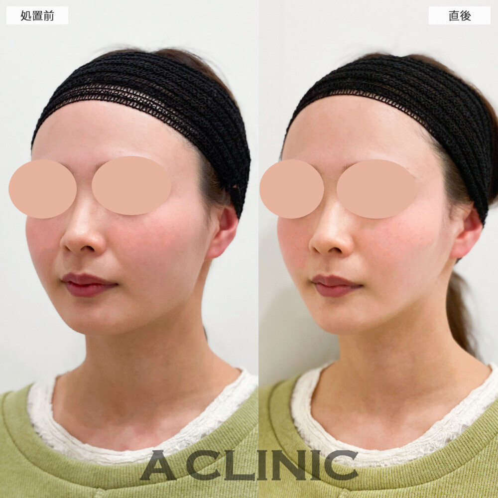 Aスレッドでほうれい線も改善され若返りました！こちら処置前と直後の症例です(20代女性)