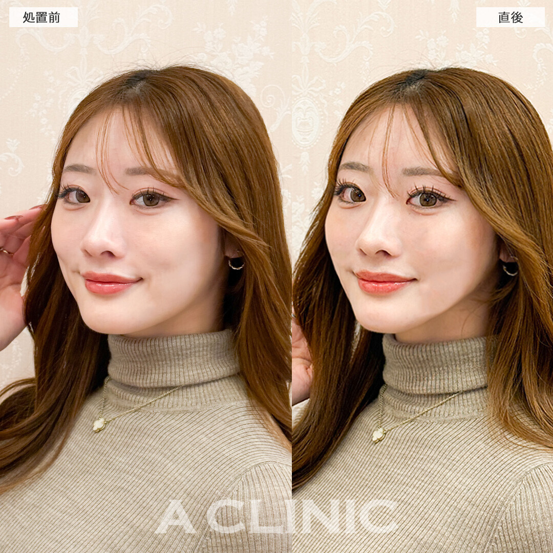 Aスレッドで輪郭が整い更に美人に！こちら処置前と直後の症例です(20代女性)