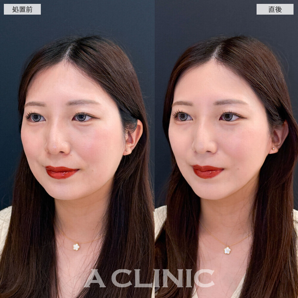 Aスレッドで丸顔から卵型の輪郭に！こちら処置前と直後の症例です(20代女性)