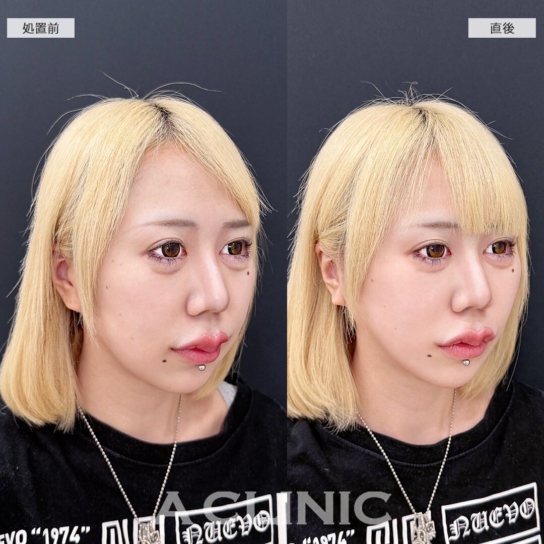Aスレッドでもたつきをグイっと引き上げて超シャープなフェイスラインに！こちら処置前と直後の症例です(20代女性)