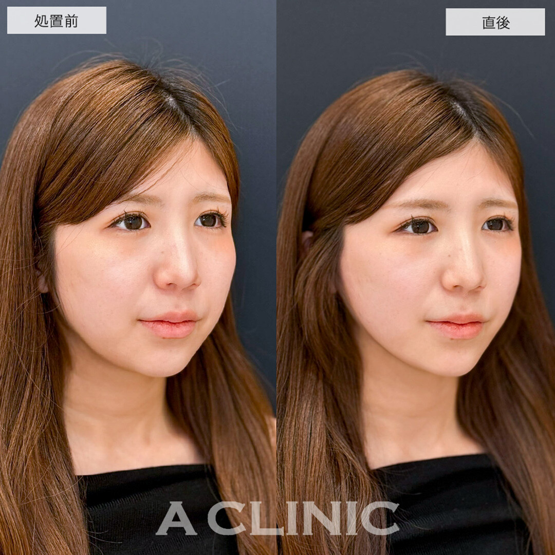 Aスレッドで即日理想の逆三角形の輪郭に!こちら処置前と直後の症例です(20代女性)