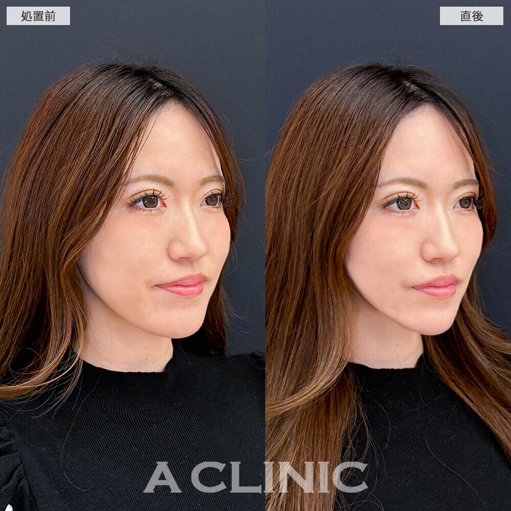 Aスレッドで気になる口横のたるみも改善！こちら処置前と直後の症例です(30代女性)