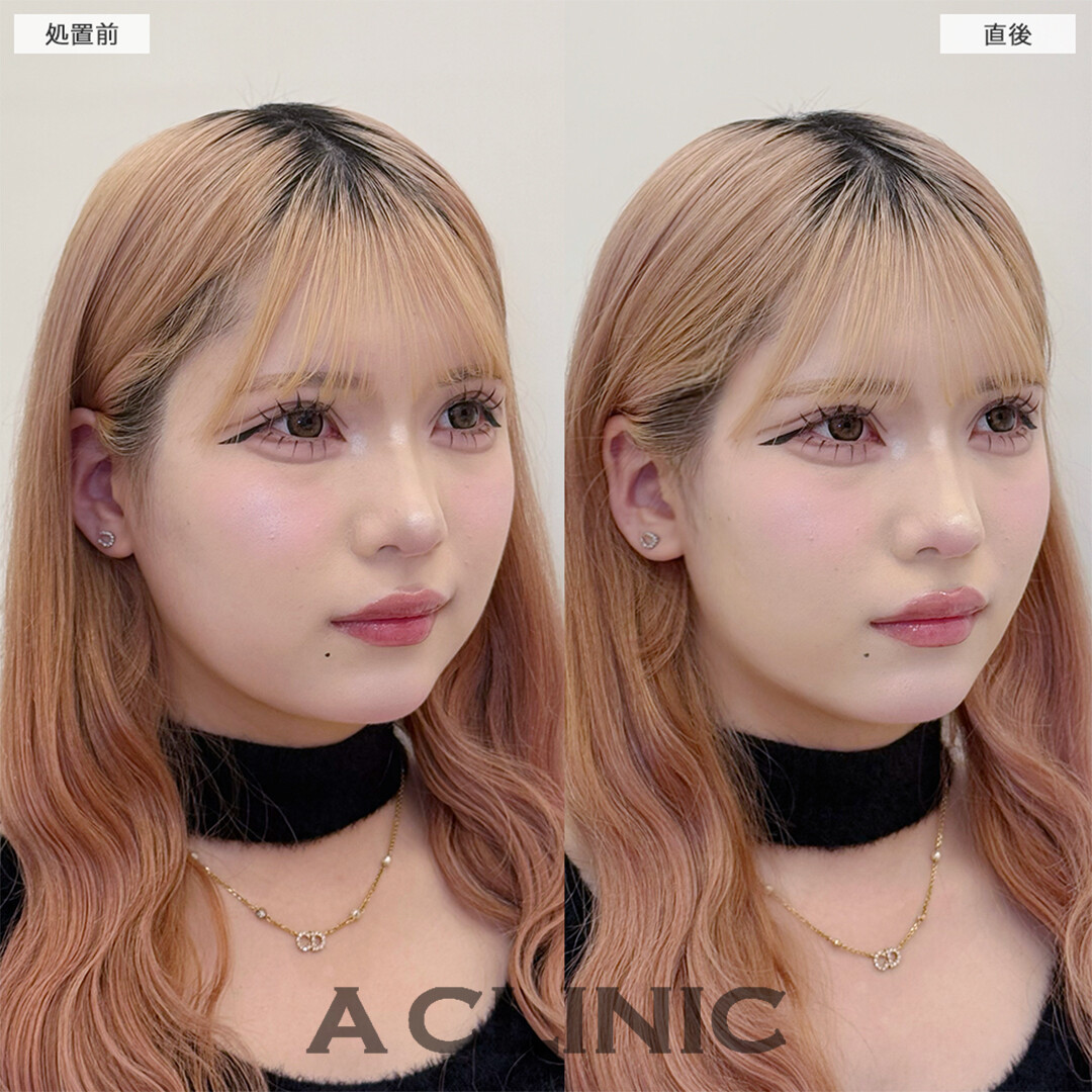 Aスレッドで丸顔がここまで変わりました！こちら処置前と直後の症例です(20代女性)